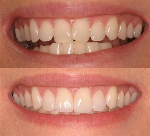 teeth bad veneers repairing fix fixed dental own before cascade