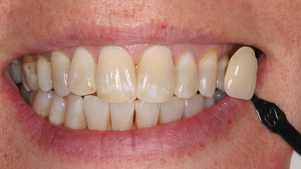 tooth whitening - before