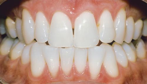 tooth colored fillings - after