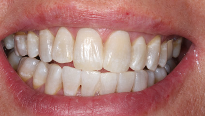 tooth whitening - after